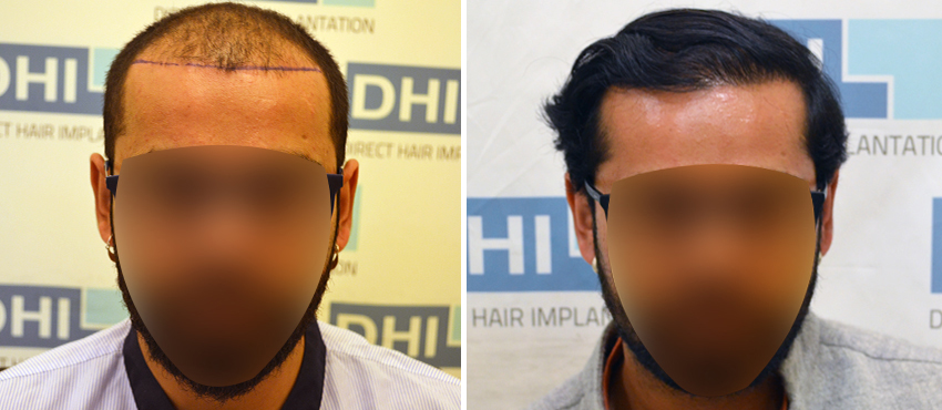 DHI before & after hair transplant results